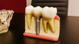 Read more about the article What Is Titanium Tooth Durability?