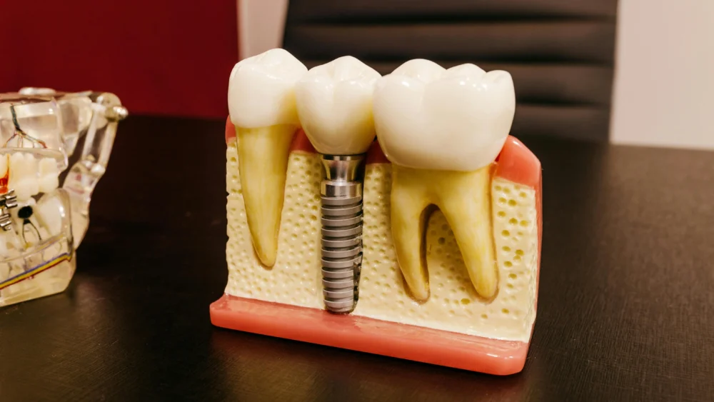 You are currently viewing What Is Titanium Tooth Durability?